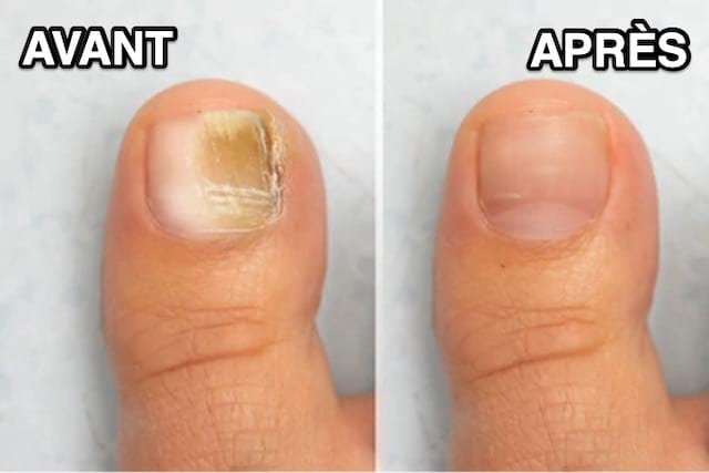 Comment soigner une mycose de l'ongle (main, pied) ?